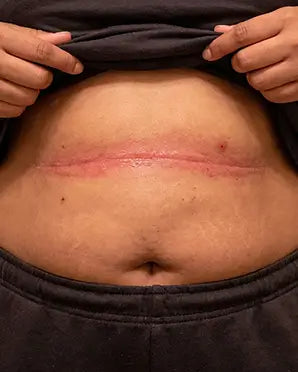 Pliegues Del Vientre / Abdomen - Antes
