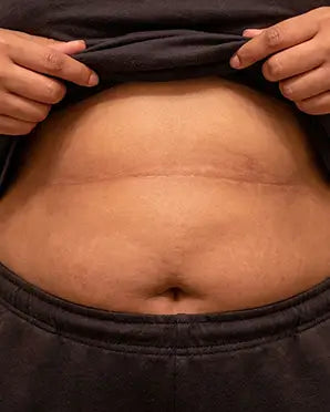 Pliegues Del Vientre / Abdomen - Despues