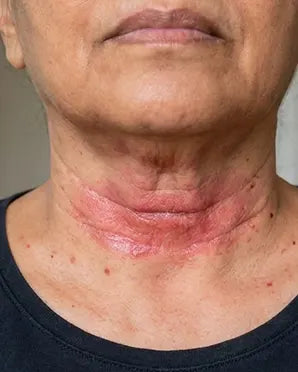 Pliegue Del Cuello - Antes
