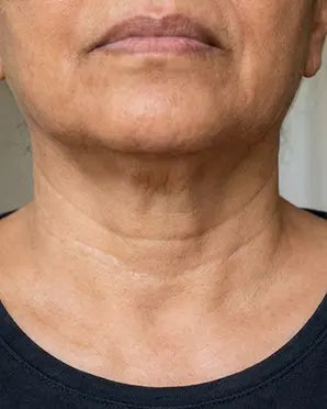 Pliegue Del Cuello - Despues